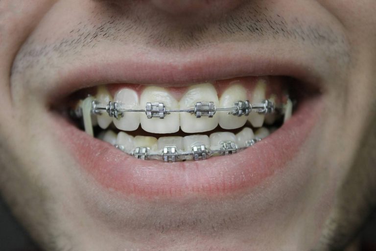 Close-up of a person smiling with newly placed metal braces, showing what braces look like during the first week.