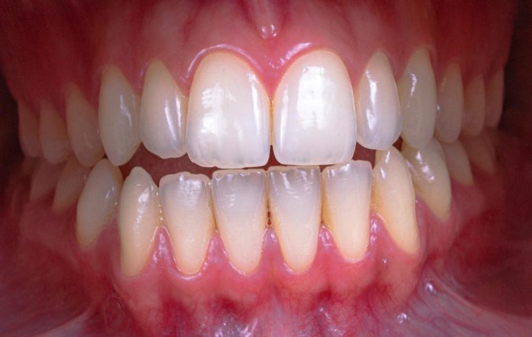 Close-up of teeth showing red, inflamed gums as an early sign of periodontitis