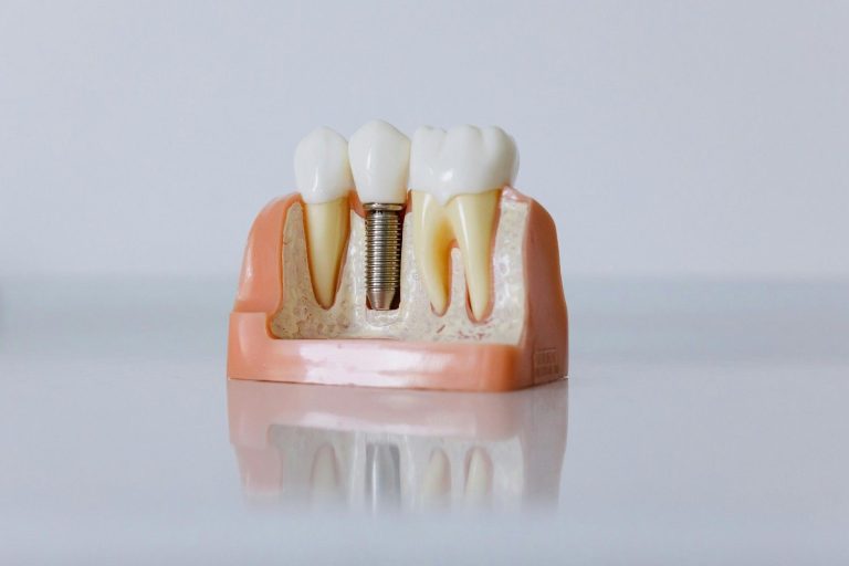 Dental implant model showing implant post integrated into jawbone for patient with gum disease