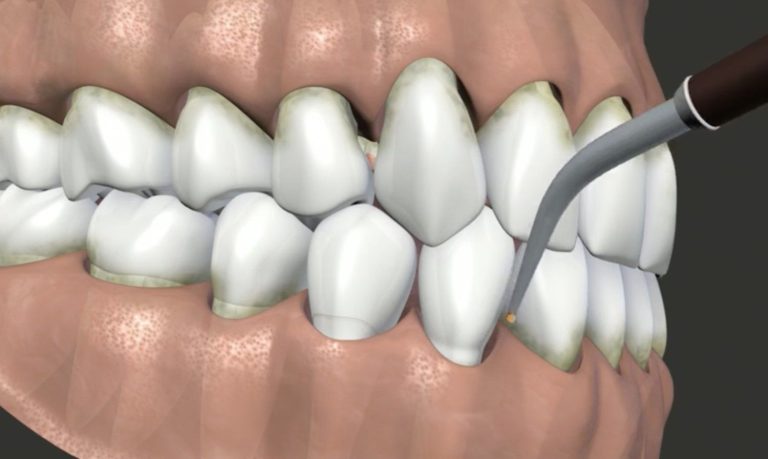 Dental laser treating inflamed gums showing early signs of gum disease