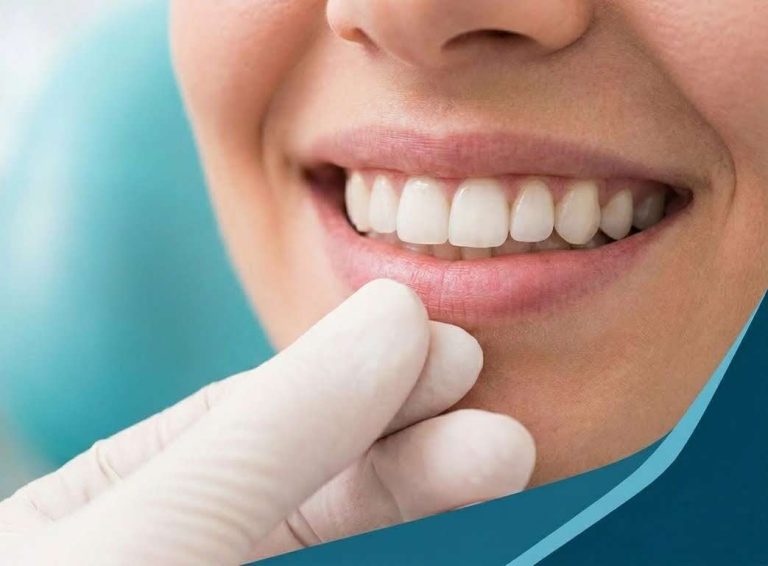 Close-up of a bright, even smile with porcelain veneers being examined by a dentist's gloved hand